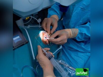 (ویدئو) عمل حذف عینک از نمایی نزدیک/ برش بسیار نازک لایه‌ای از چشم توسط لیزر