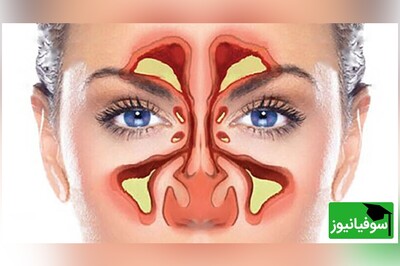 ویدیو/ درمان فوری سینوزیت در طب ایرانی