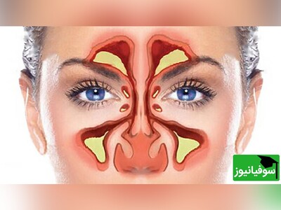 ویدیو/ درمان فوری سینوزیت در طب ایرانی