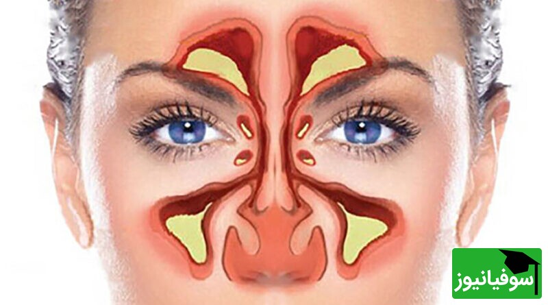 ویدیو/ درمان فوری سینوزیت در طب ایرانی