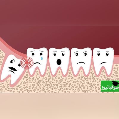 (ویدئو) چرا باید دندان عقل را کشید؟/ کیا هنوز دندون عقلشون مونده این کلیپ رو حتماً ببینن