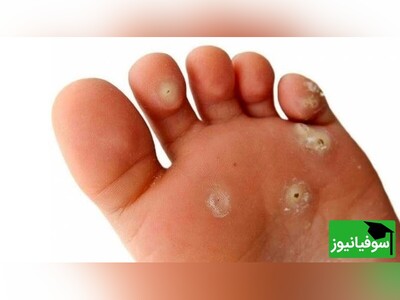 ویدیو/ علت ایجاد میخچه در پا/ آسان‌ترین روش نابودی میخچه بدون درد و خون‌ریزی