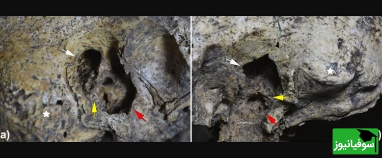 کشف جمجمه‌ای با قدیمی‌ترین شواهد جراحی گوش