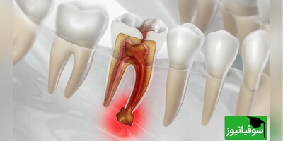 ویدیو/ خطرات وحشتناک عفونت دندان برای مغز/ پس از ورود باکتری به استخوان فک و جریان خون چه اتفاقی برای مغز می‌افتد؟