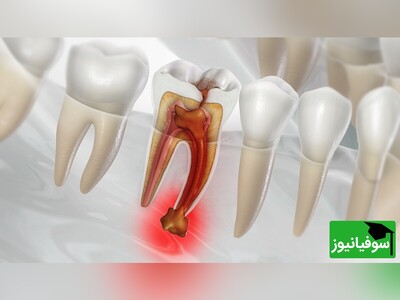 ویدیو/ خطرات وحشتناک عفونت دندان برای مغز/ پس از ورود باکتری به استخوان فک و جریان خون چه اتفاقی برای مغز می‌افتد؟