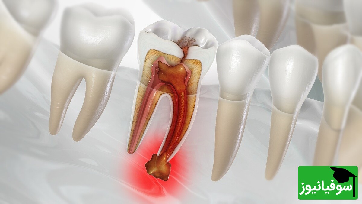 ویدیو/ خطرات وحشتناک عفونت دندان برای مغز/ پس از ورود باکتری به استخوان فک و جریان خون چه اتفاقی برای مغز می‌افتد؟