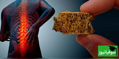 ویدیو / پوکی استخوان، علائم و راه‌های پیشگیری موثر از ابتلا