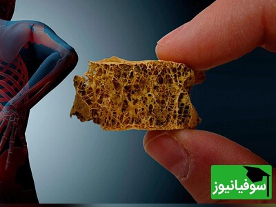 ویدیو / پوکی استخوان، علائم و راه‌های پیشگیری موثر از ابتلا