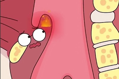 (ویدئو) اپی‌گلوتیت حاد چیست و چرا ممکن است بعد از یک لقمه داغ سراغتان بیاید؟