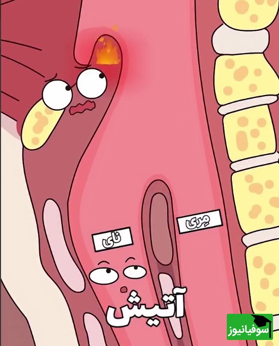 (ویدئو) اپی‌گلوتیت حاد چیست و چرا ممکن است بعد از یک لقمه داغ سراغتان بیاید؟