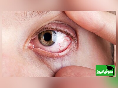 ویدیو/ کِرم‌های شناور نامرئی در چشم چه می‌کنند؟/ بیماری فلوتر یا مگس‌پران را بشناسیم