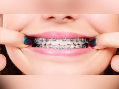 (ویدئو) تجربۀ دردناک ارتودنسی دندان از نمای بسیار نزدیک