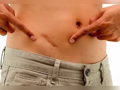 (ویدیو) کشف شگفت‌انگیز درباره آپاندیس؛ آیا این قسمت غیر فعال بدن در حقیقت یک گنجینه بی‌نظیر است؟ / ماجرای کاربردهای فراموش‌شده آپاندیس پس از میلیون‌ها سال فاش شد!