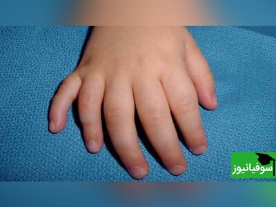 (ویدئو) تبدیل انسان 5 انگشتی، به انسان 6 انگشتی/ فناوری عجیب ساخت انگشت رباتیک