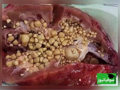 ویدیویی جالب از نحوۀ عمل سنگ کلیه به روش  TUL