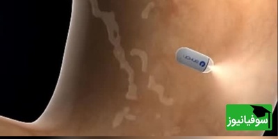 (ویدئو) از کابوس تا کپسول؛ آندوسکوپی بدون دردسر