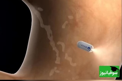 (ویدئو) از کابوس تا کپسول؛ آندوسکوپی بدون دردسر