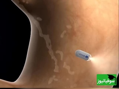 (ویدئو) از کابوس تا کپسول؛ آندوسکوپی بدون دردسر