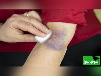 ویدئو/ علت کبودی و خون‌ مردگی پوست پس از تزریق