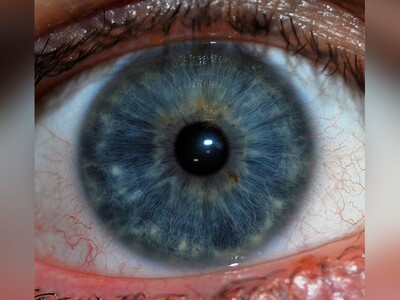 (ویدئو) بیماری عجیب «عنبیه لرزی» چشم/ این دیگه لرزش نبود، زلزلۀ 8 ریشتری بود