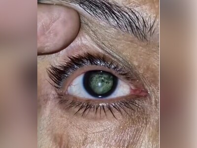 (ویدئو) بیماری عجیب چشم کهکشانی/ اختلال یا  انعکاس تصویر ستارگان در چشم