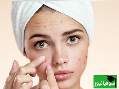 (ویدئو) هشدار! قبل از ترکاندن جوش‌هایتان این ویدئو را ببینید؛ گلبول‌های سفیدتان به کمک شما نیاز دارند!