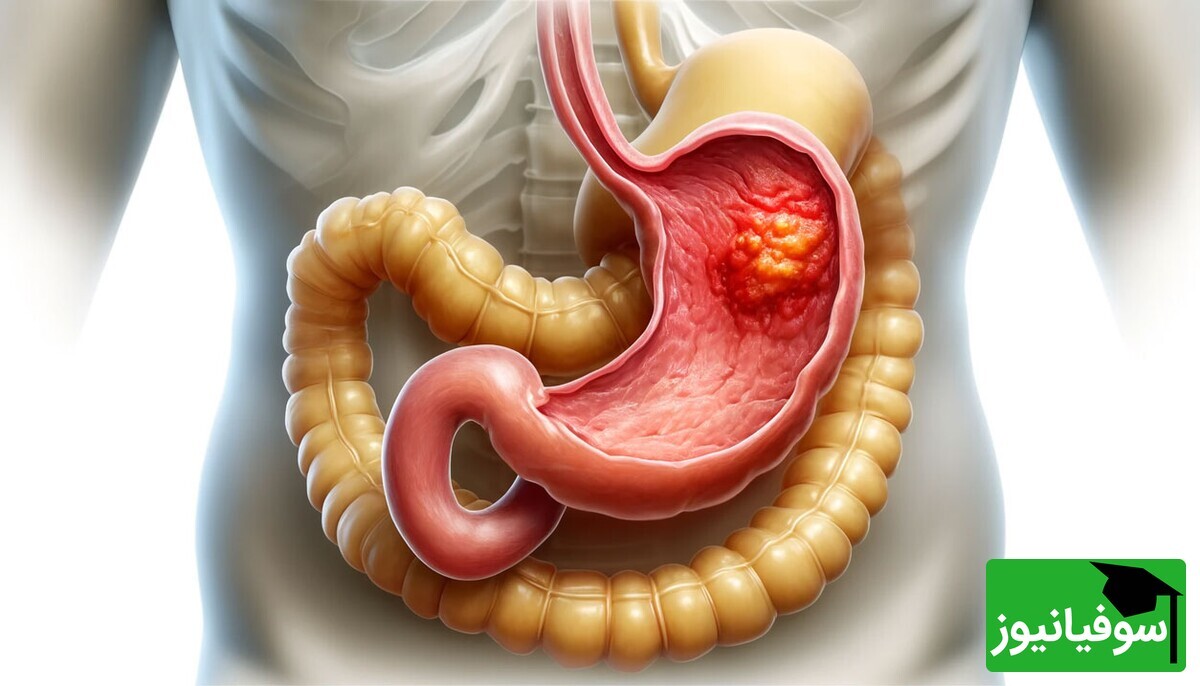 زخم معده چیست؛ از علل و علائم تا درمان و جراحی