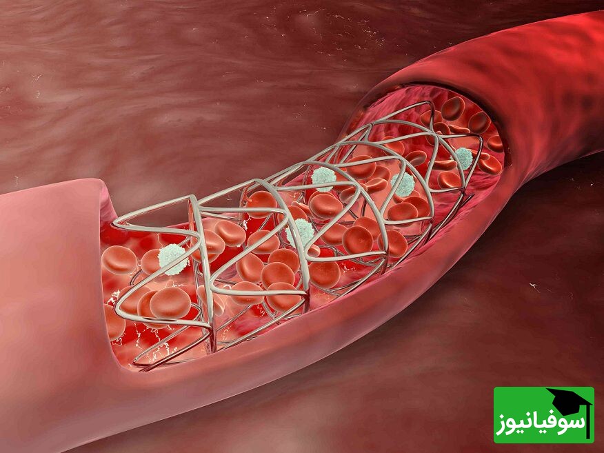 (ویدئو) عملکرد دیدنی استنت یا فنر قلب از نمایی بسیار نزدیک