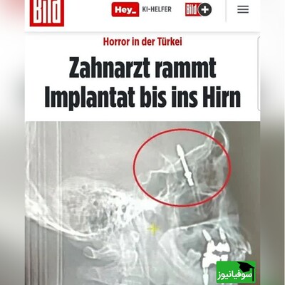 (ویدئو) دندانپزشک ترکیه‌ای ایمپلنت را در مغز بیمار فرو کرد!