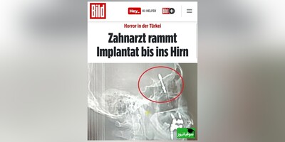(ویدئو) دندانپزشک ترکیه‌ای ایمپلنت را در مغز بیمار فرو کرد!