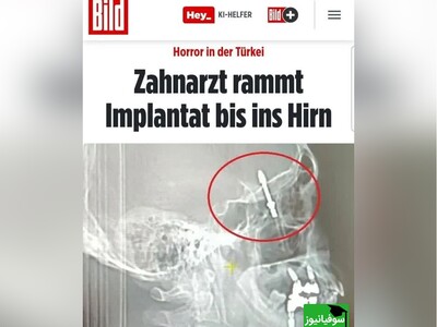 (ویدئو) دندانپزشک ترکیه‌ای ایمپلنت را در مغز بیمار فرو کرد!