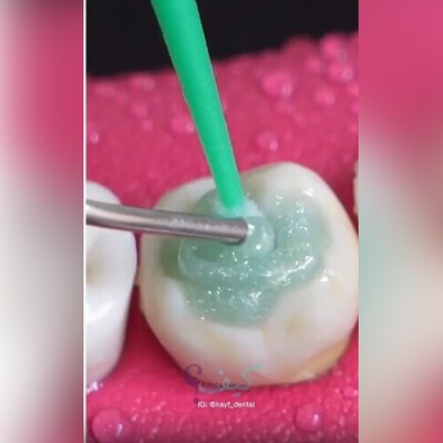 (ویدئو) ترمیم و بازسازی دندان‌های پوسیده از نمایی نزدیک