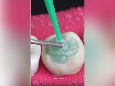 (ویدئو) ترمیم و بازسازی دندان‌های پوسیده از نمایی نزدیک